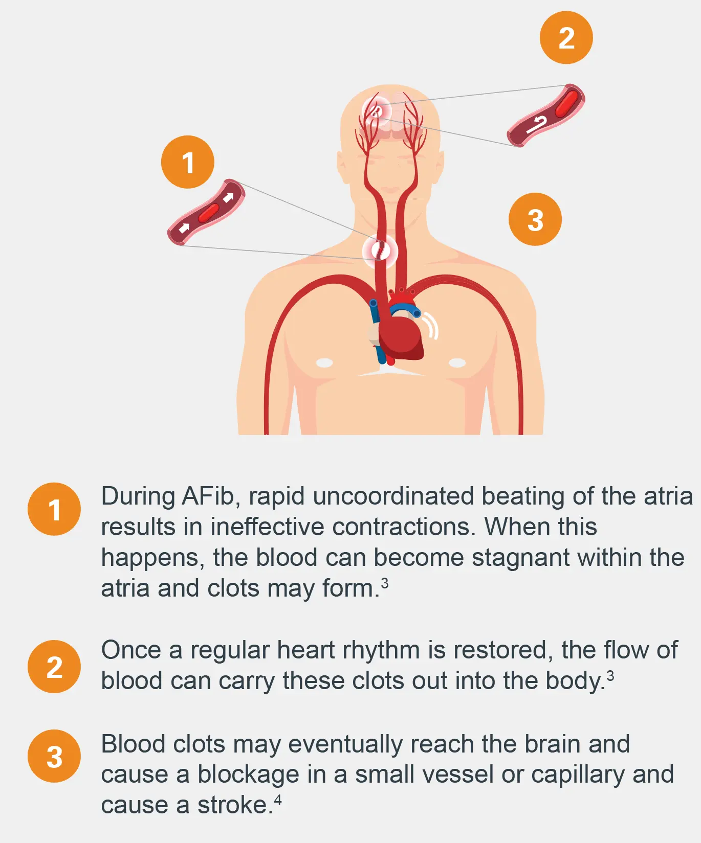 Stroke &#8211; the greatest enemy of patients with atrial fibrillation