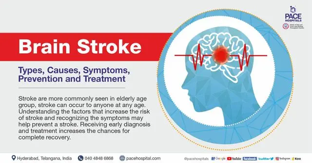 Stroke &#8211; what is it, causes, symptoms, diagnosis, treatment