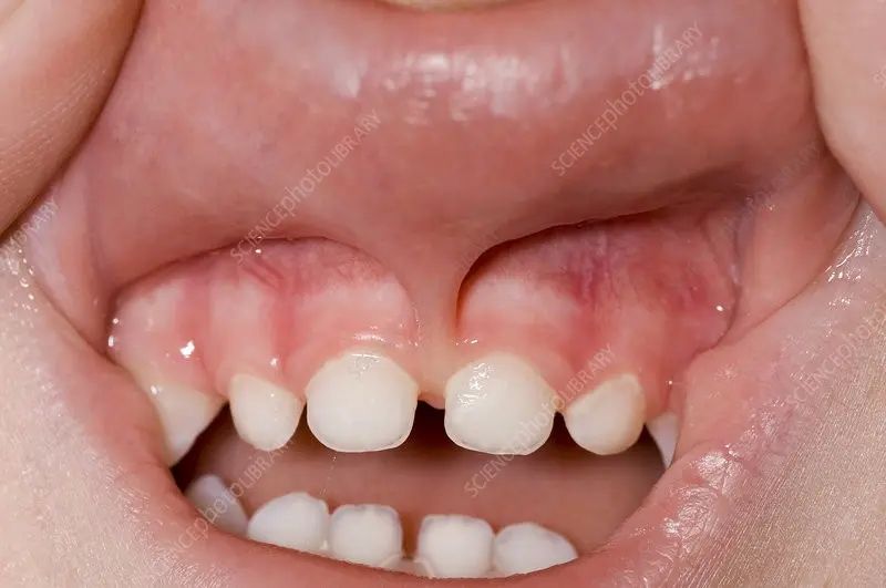 Sub-lip frenulum
