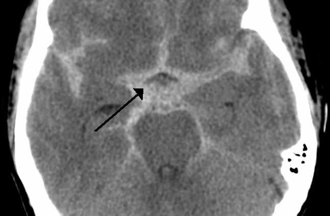 Subarachnoid hemorrhage