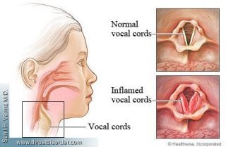 Subglottic laryngitis &#8211; causes, symptoms and treatment