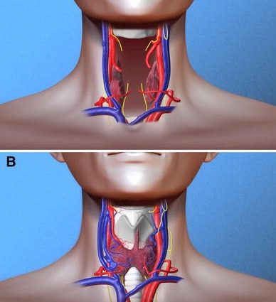 Successful laryngeal transplant surgery