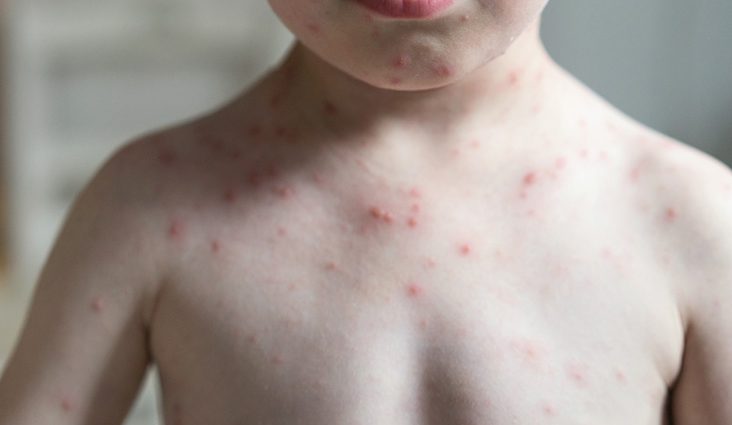 Sudden erythema (three-day fever) &#8211; symptoms and treatment in children