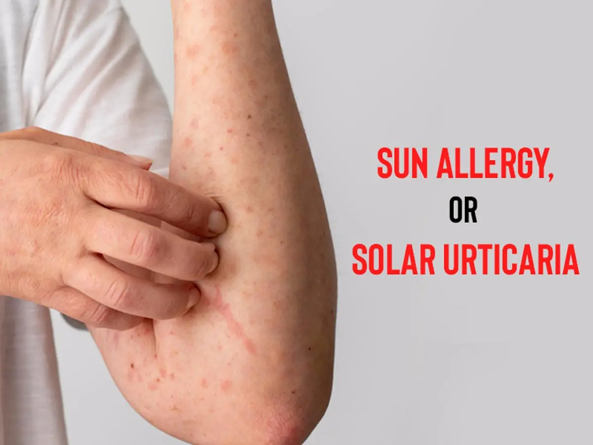 Sun allergy &#8211; causes, symptoms, treatment, prevention