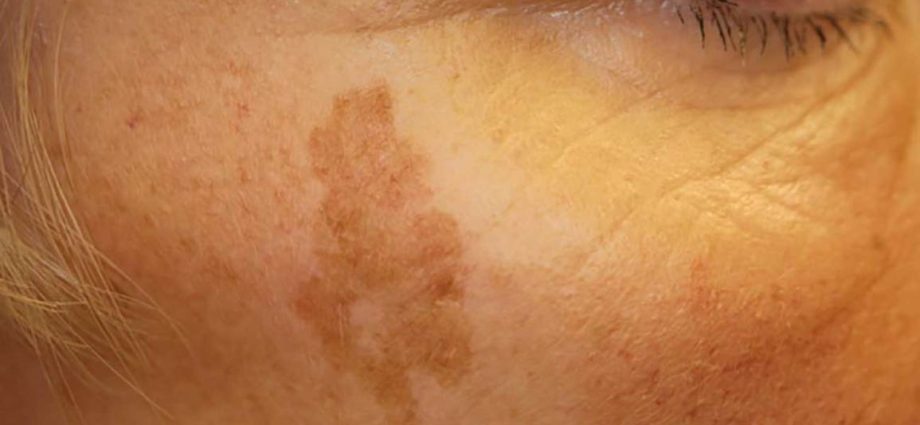 Sunspots. How to protect yourself from discoloration and burns?