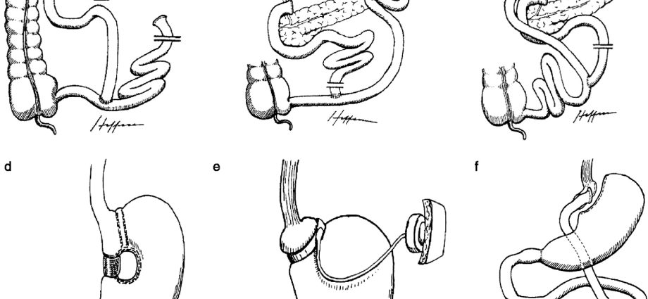 Surgical methods of fighting obesity