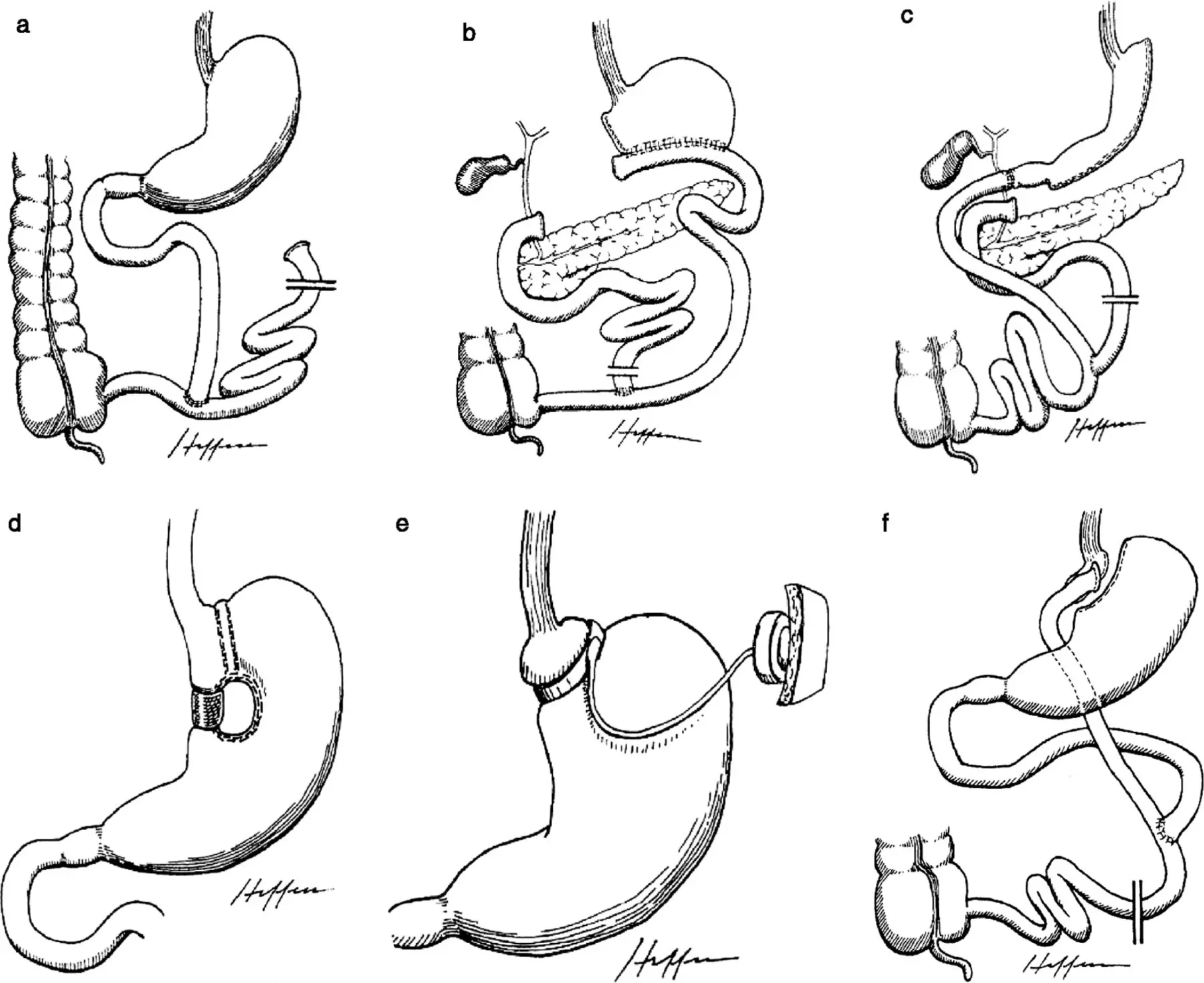 Surgical methods of fighting obesity