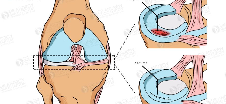 Surgical treatment of meniscal ruptures