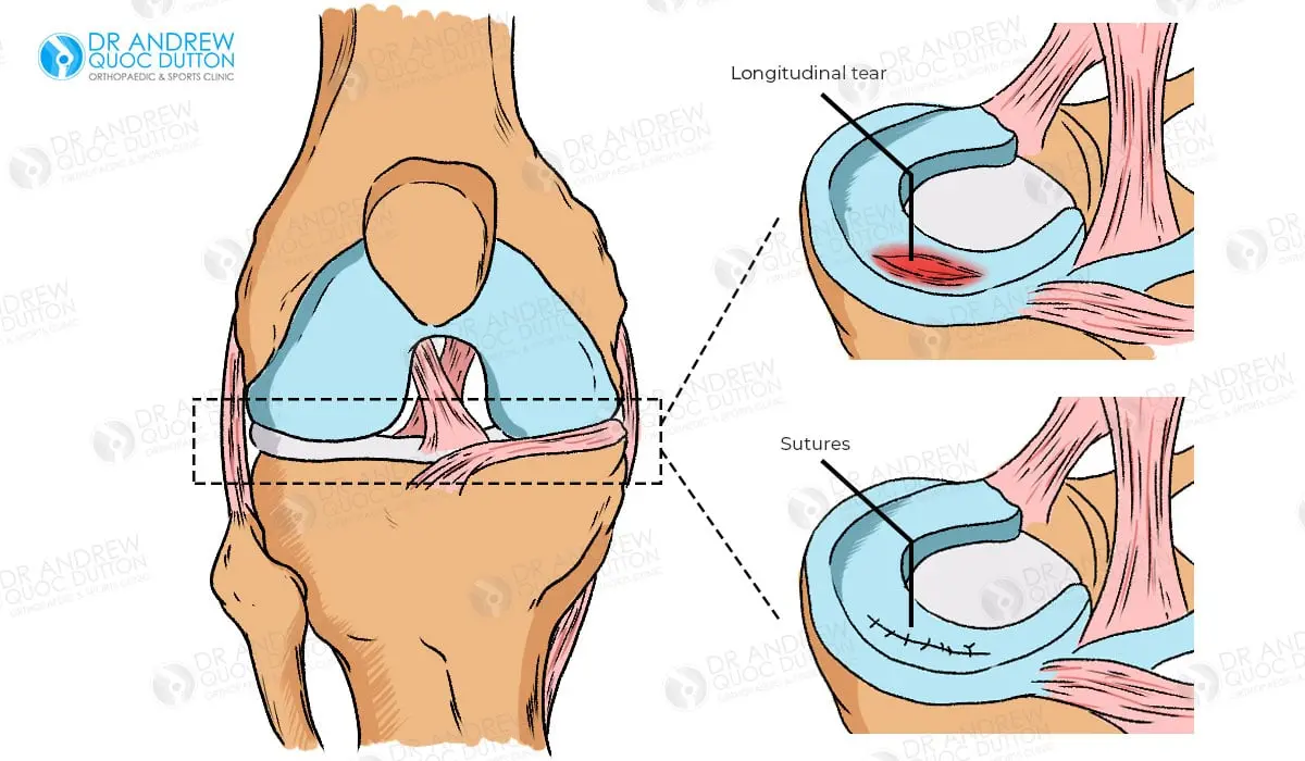 Surgical treatment of meniscal ruptures