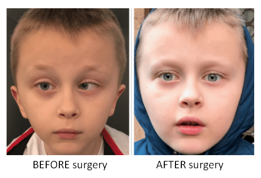 Surgical treatment of strabismus in children