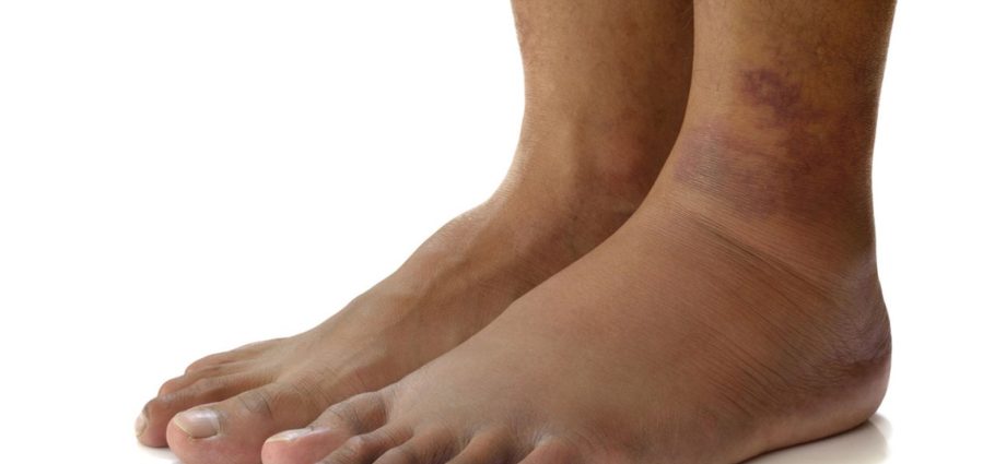 Swelling of the leg may be a symptom of a life-threatening disease