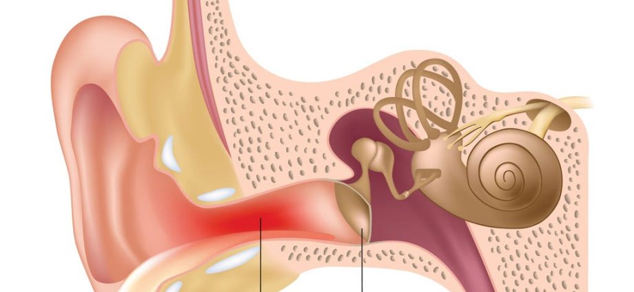 Swimmer&#8217;s ear &#8211; blue pus stick, treatment, prophylaxis of otitis