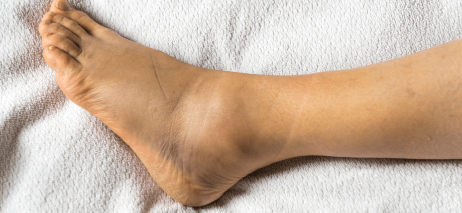 Swollen Ankles Causes Symptoms Of What Diseases Prevention