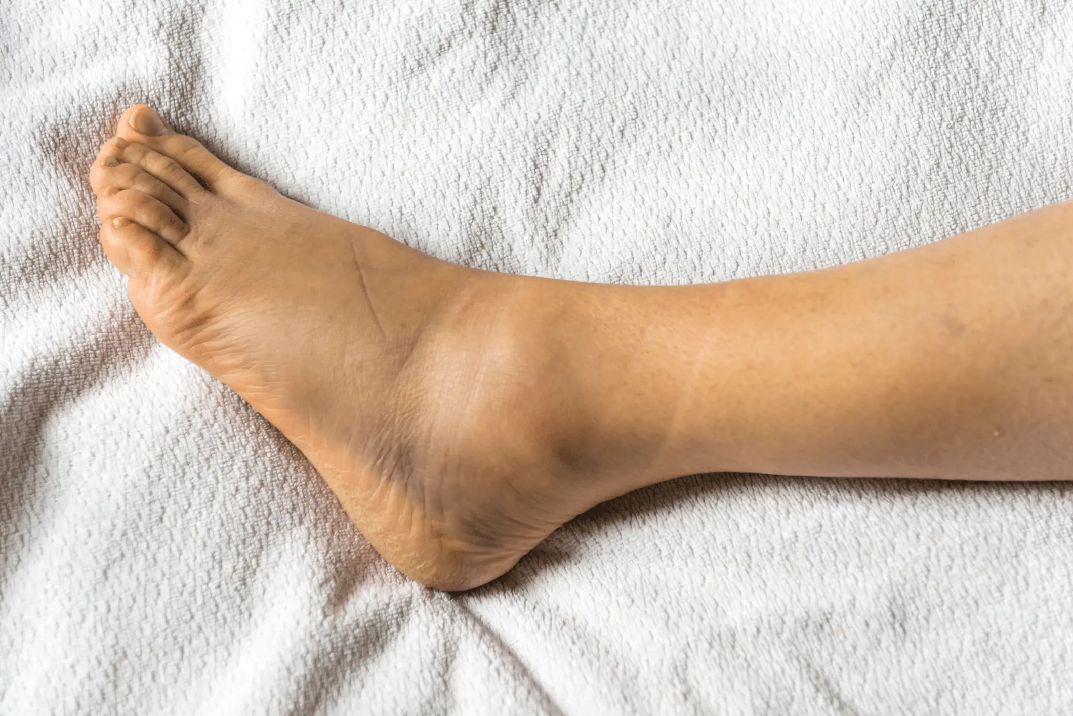 Swollen ankles &#8211; causes, symptoms of what diseases, prevention