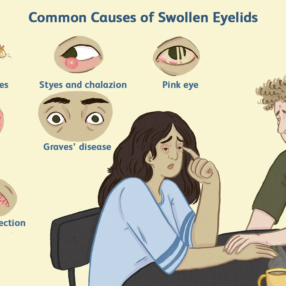 Swollen eyes &#8211; the most common causes. What helps with puffy eyes?