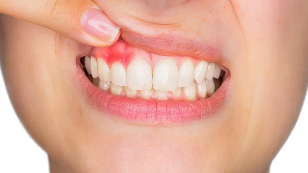 Swollen gum &#8211; causes, treatment