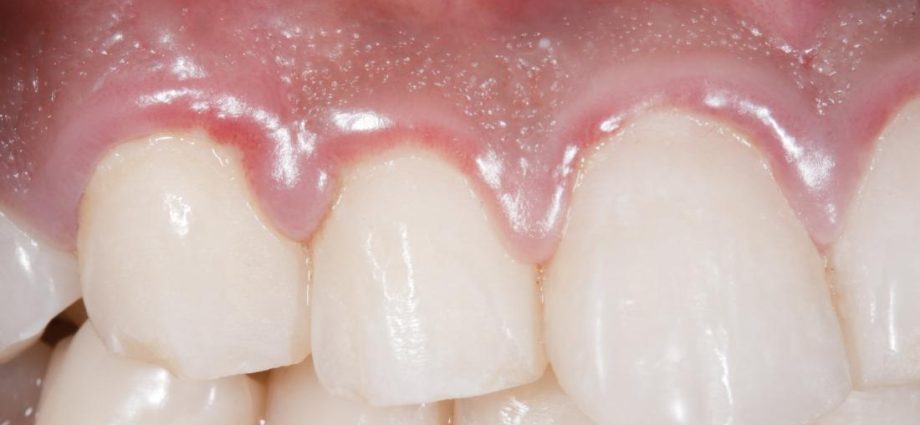 Swollen gums &#8211; causes. How to treat swollen gums?