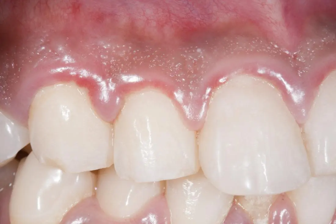 Swollen gums &#8211; causes. How to treat swollen gums?