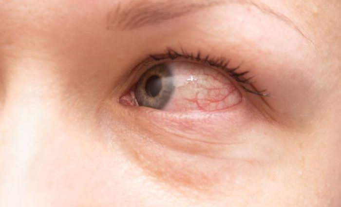 Symptoms of allergic conjunctivitis &#8211; you should not take them lightly