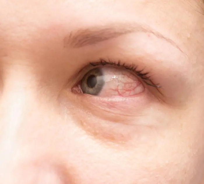 Symptoms of allergic conjunctivitis &#8211; you should not take them lightly