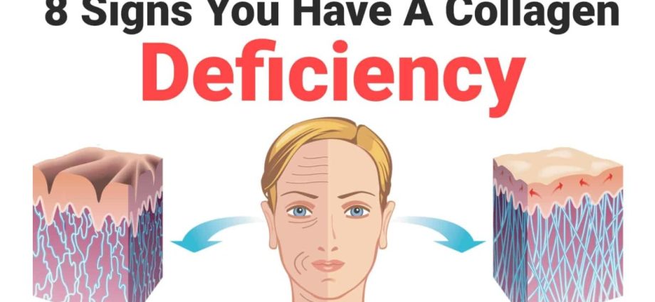 Symptoms of collagen deficiency &#8211; signs can be seen on the skin and more