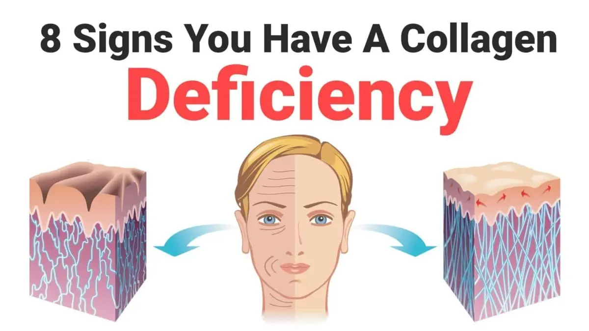 Symptoms of collagen deficiency &#8211; signs can be seen on the skin and more