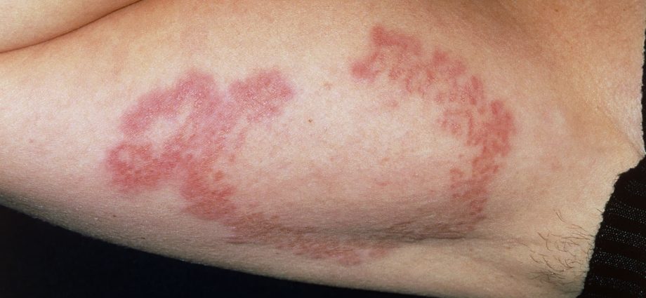 Symptoms of diabetes that appear on the skin