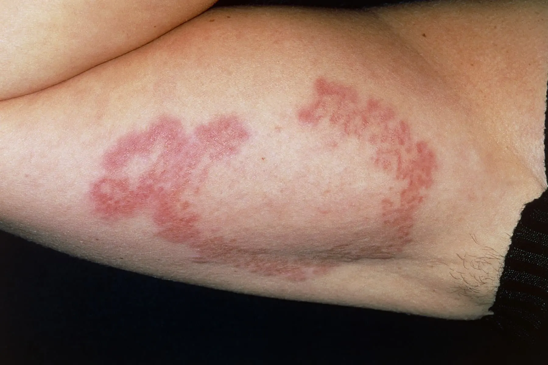 Symptoms of diabetes that appear on the skin