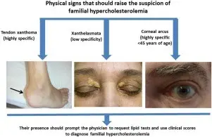 Symptoms of familial hypercholesterolaemia that everyone should know [EXPLAINED]