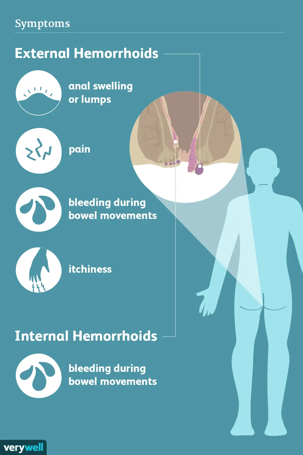 Symptoms of hemorrhoids &#8211; causes and treatment. The most common symptoms of hemorrhoids