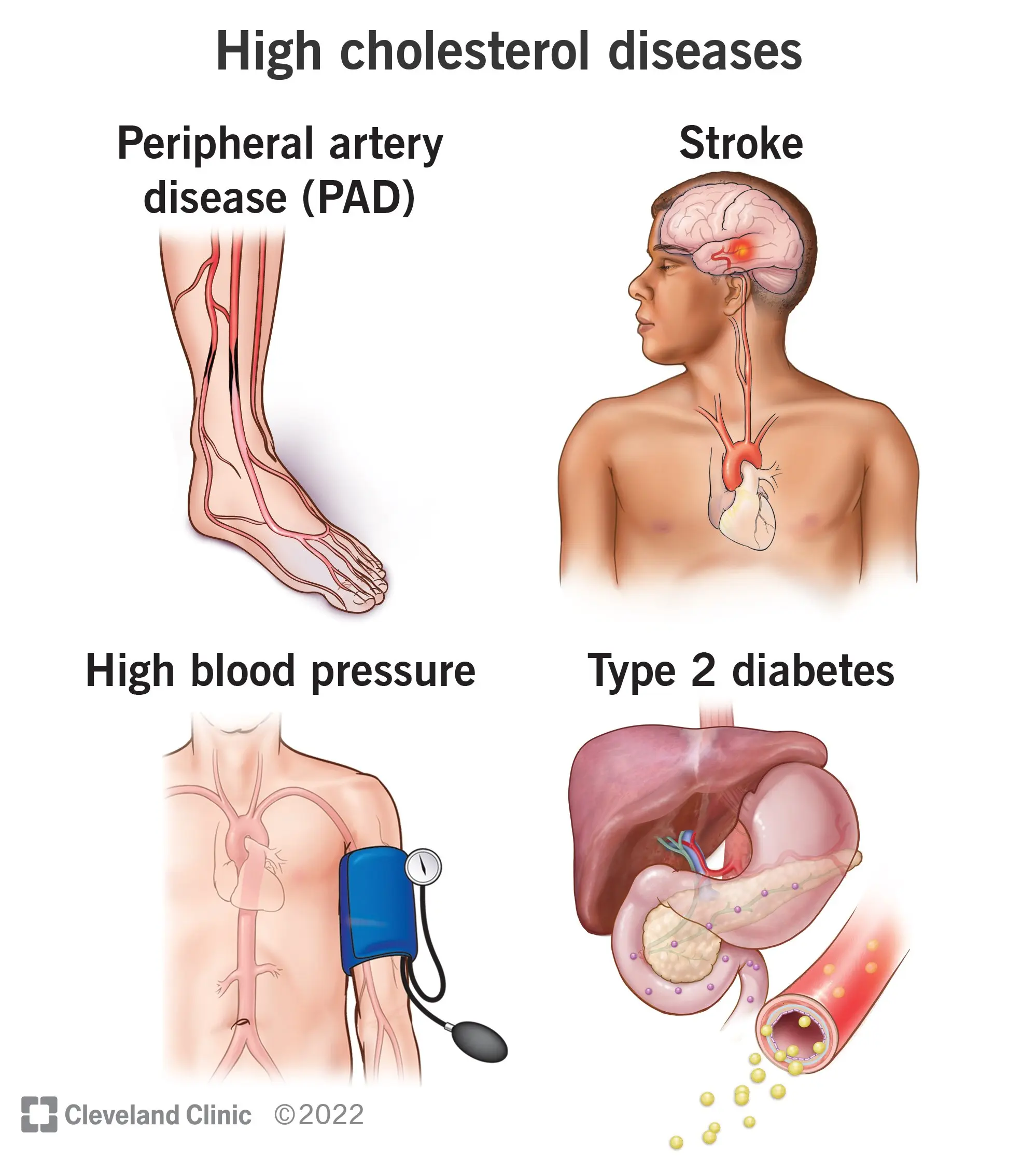 Symptoms of high cholesterol