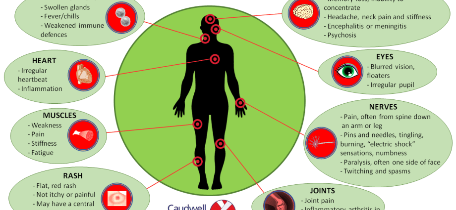 Symptoms of Lyme disease years after the bite. They silently exhaust the body