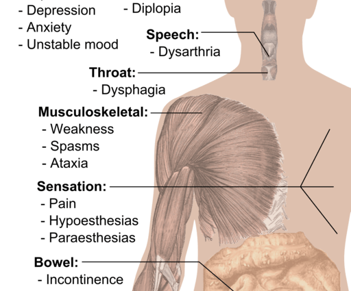 Symptoms of multiple sclerosis, part 1