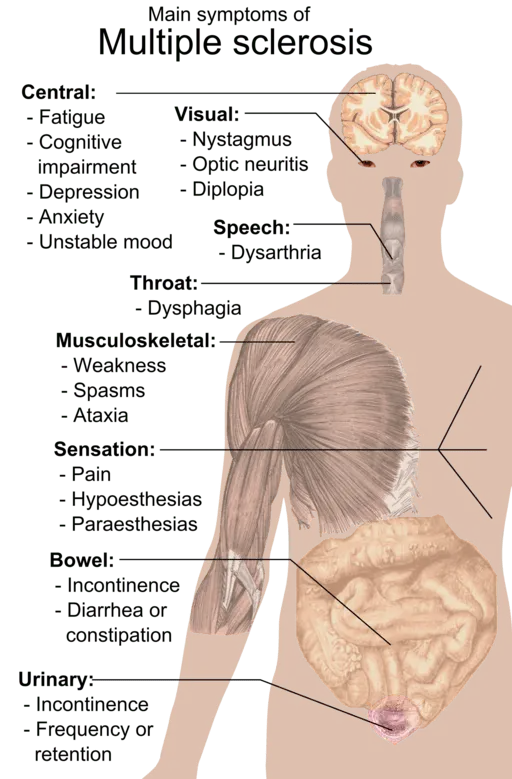 Symptoms of multiple sclerosis, part 2.