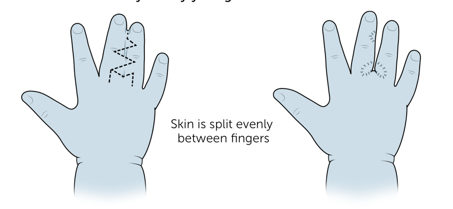 Syndactyly &#8211; description, causes, treatment