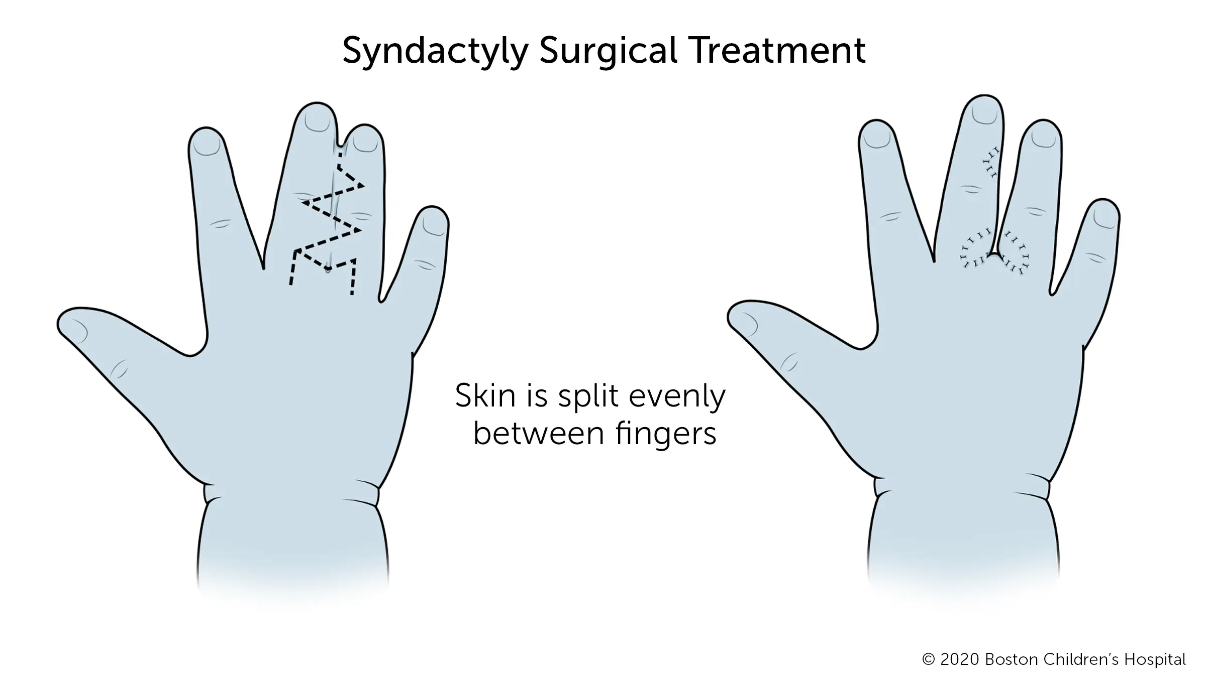 Syndactyly &#8211; description, causes, treatment