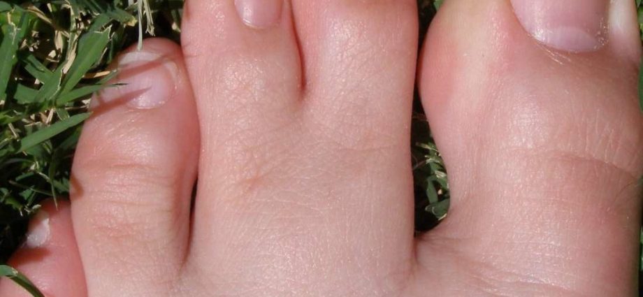 Syndactyly &#8211; what is it, treatment. How to deal with this toe deformity?