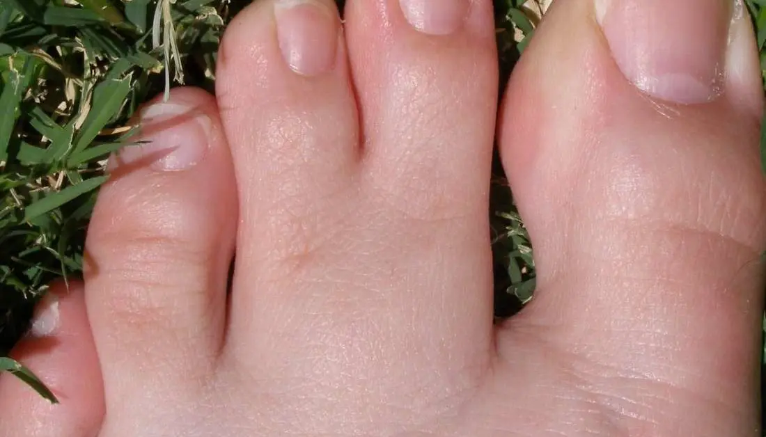 Syndactyly &#8211; what is it, treatment. How to deal with this toe deformity?