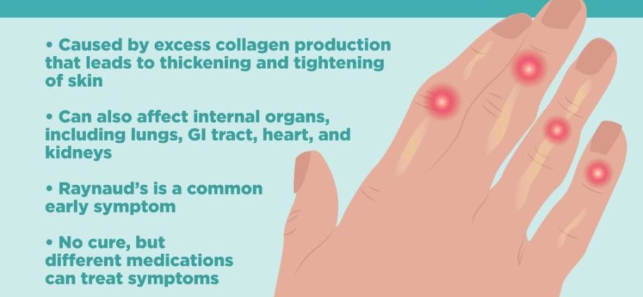 Systemic sclerosis &#8211; a disease that &#8220;takes your face&#8221;. What is it and what does its diagnosis look like?