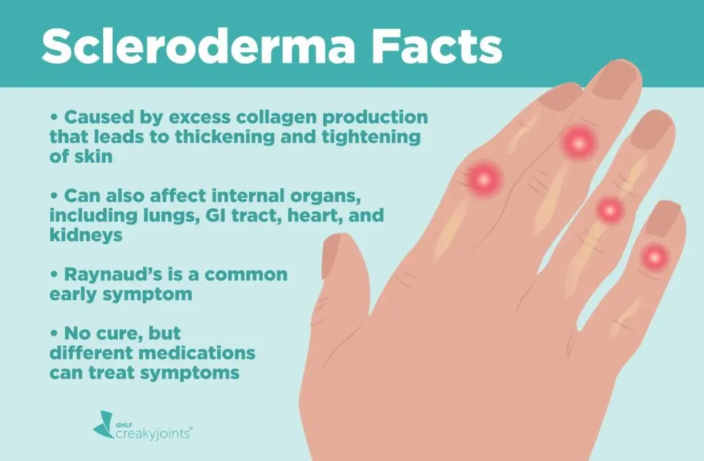 Systemic sclerosis &#8211; a disease that &#8220;takes your face&#8221;. What is it and what does its diagnosis look like?