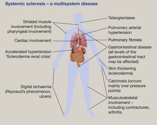 Systemic sclerosis &#8211; what is it and what are its symptoms?