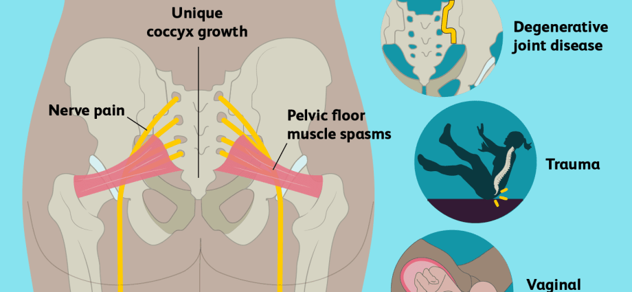 Tailbone pain