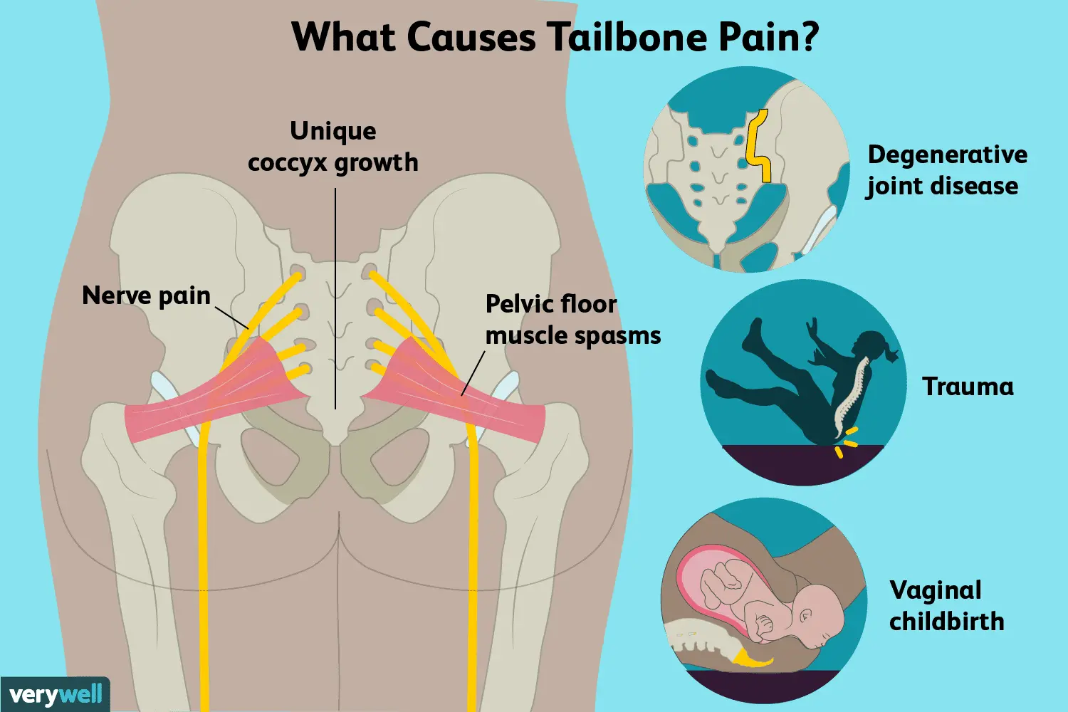 Tailbone pain