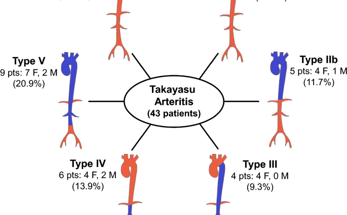 Takayasu&#8217;s disease &#8211; types, research, treatment. What is aortic arch syndrome?