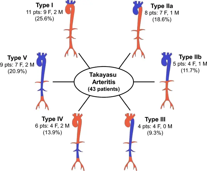 Takayasu&#8217;s disease &#8211; types, research, treatment. What is aortic arch syndrome?