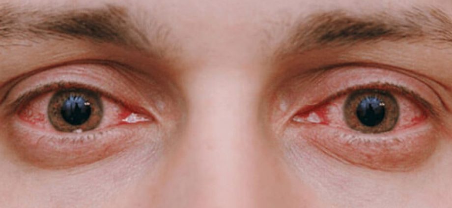 Take a look at your eyes. These changes are a sign that your body is in poor condition