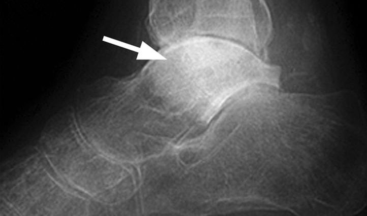 Talus bone &#8211; structure and fractures. What is Talus Necrosis?