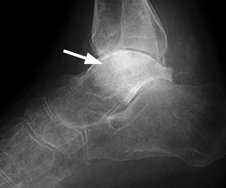 Talus bone &#8211; structure and fractures. What is Talus Necrosis?