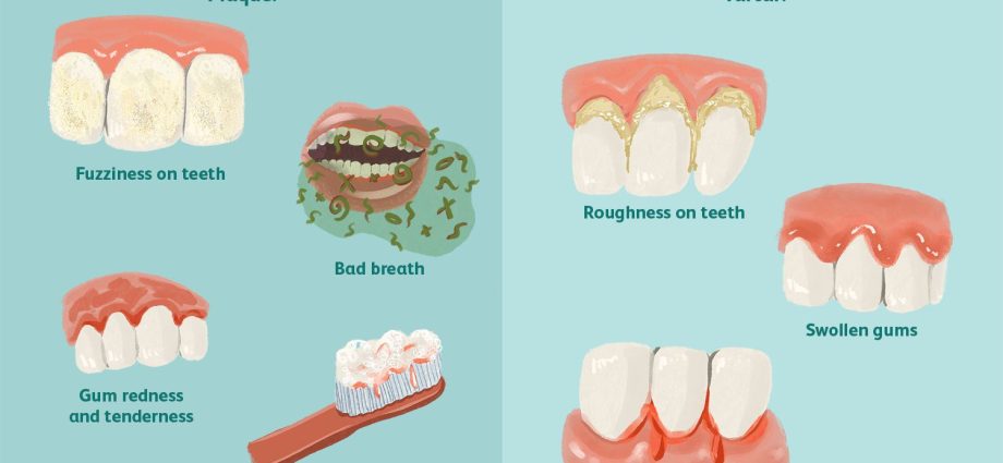 Tartar &#8211; causes, symptoms, prevention. How to remove tartar?