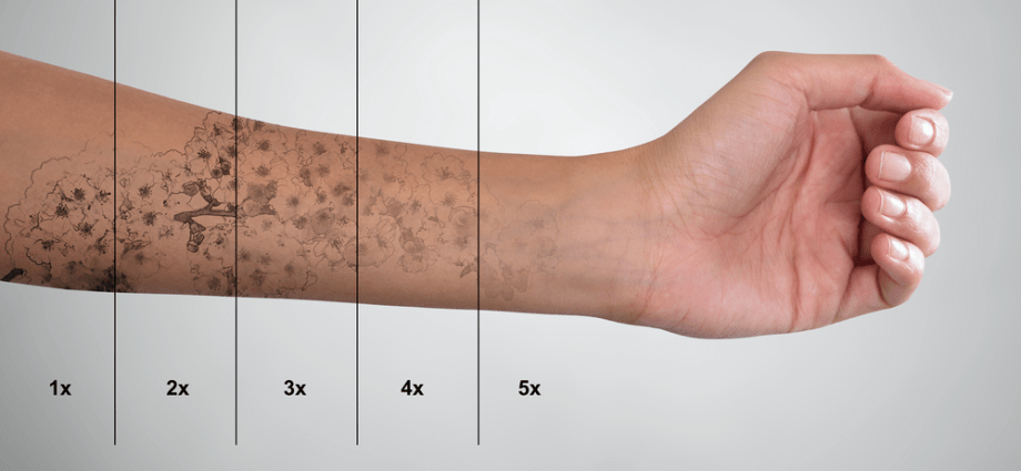 Tattoo removal &#8211; what does it look like and how much does it cost?